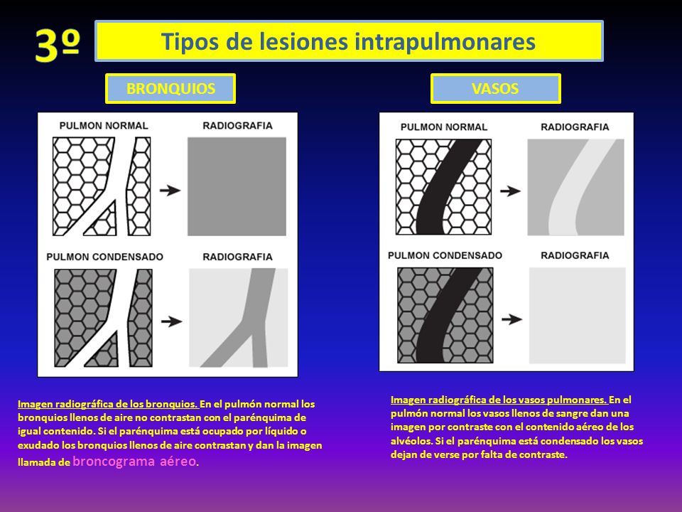 Tipos de lesiones intrapulmonares BRONQUIOSVASOS Imagen radiográfica de los bronquios.