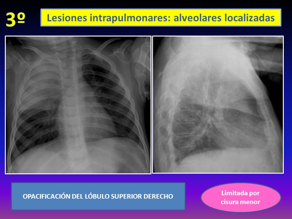 Lesiones intrapulmonares: alveolares localizadas OPACIFICACIÓN DEL LÓBULO SUPERIOR DERECHO Limitada por cisura menor