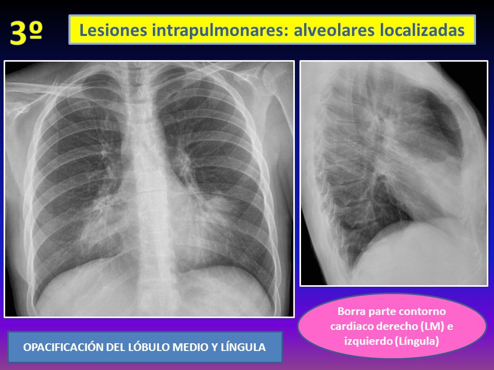 Borra parte contorno cardiaco derecho (LM) e izquierdo (Língula) OPACIFICACIÓN DEL LÓBULO MEDIO Y LÍNGULA Lesiones intrapulmonares: alveolares localizadas