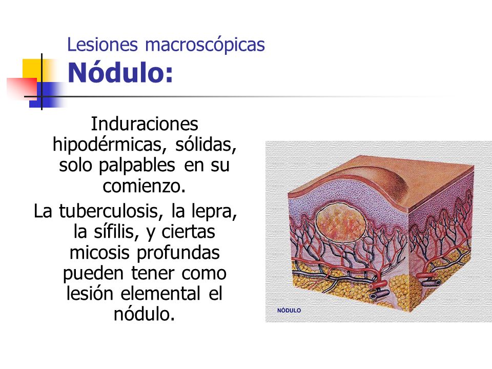 LESIONES ELEMENTALES EN LA PIEL lesiones elementales en la piel: