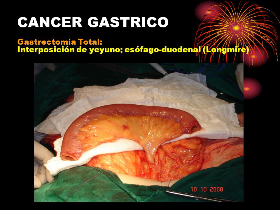 CANCER GASTRICO GASTRECTOMIA cancer gastrico gastrectomia:
