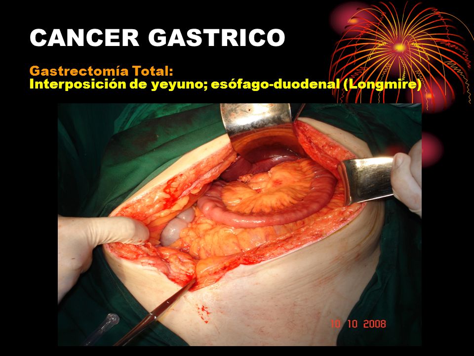 CANCER GASTRICO GASTRECTOMIA cancer gastrico gastrectomia: