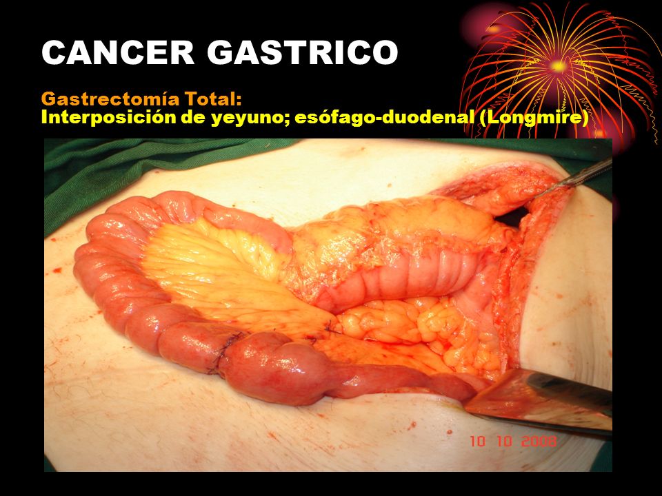 CANCER GASTRICO GASTRECTOMIA cancer gastrico gastrectomia: