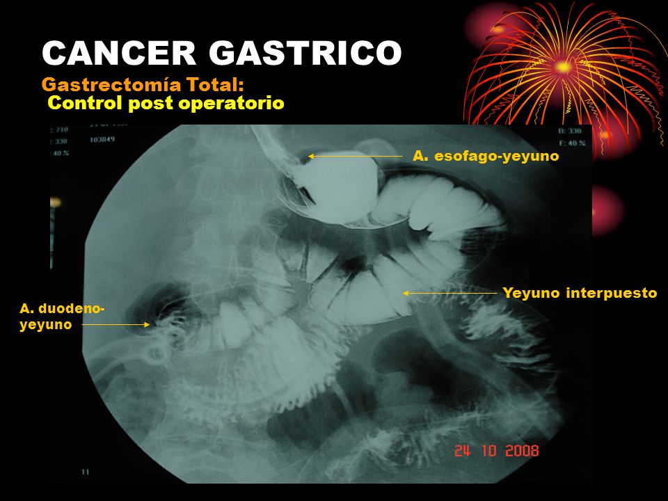 CANCER GASTRICO GASTRECTOMIA cancer gastrico gastrectomia: