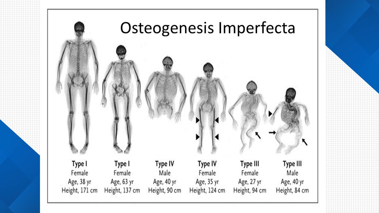 OSTEOGÉNESIS IMPERFECTA PROF JOSÉ LUIS LUNA SANCHES ppt descargar