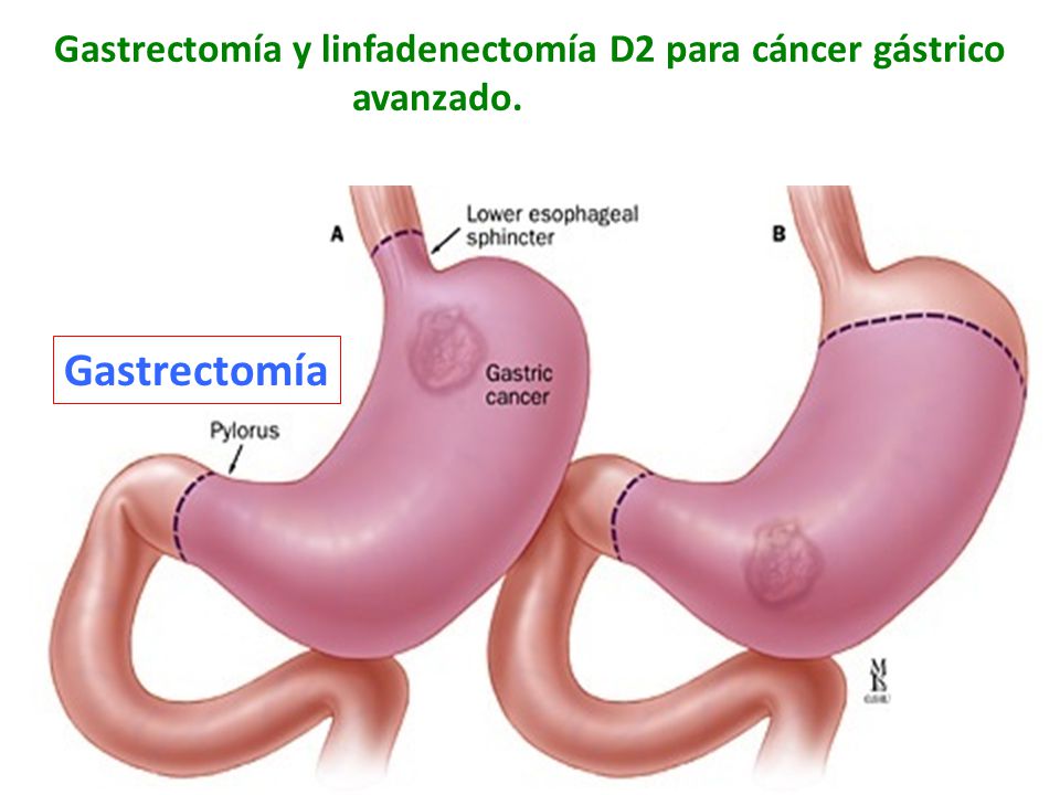 CANCER GASTRICO GASTRECTOMIA cancer gastrico gastrectomia: