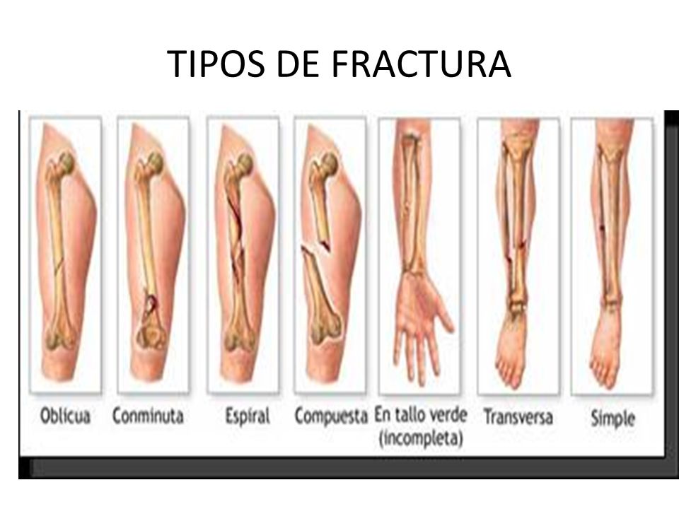 Resultado de imagen para tipos de fracturas