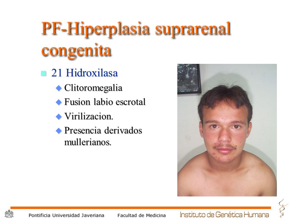 HIPERPLASIA SUPRARENAL hiperplasia suprarenal: