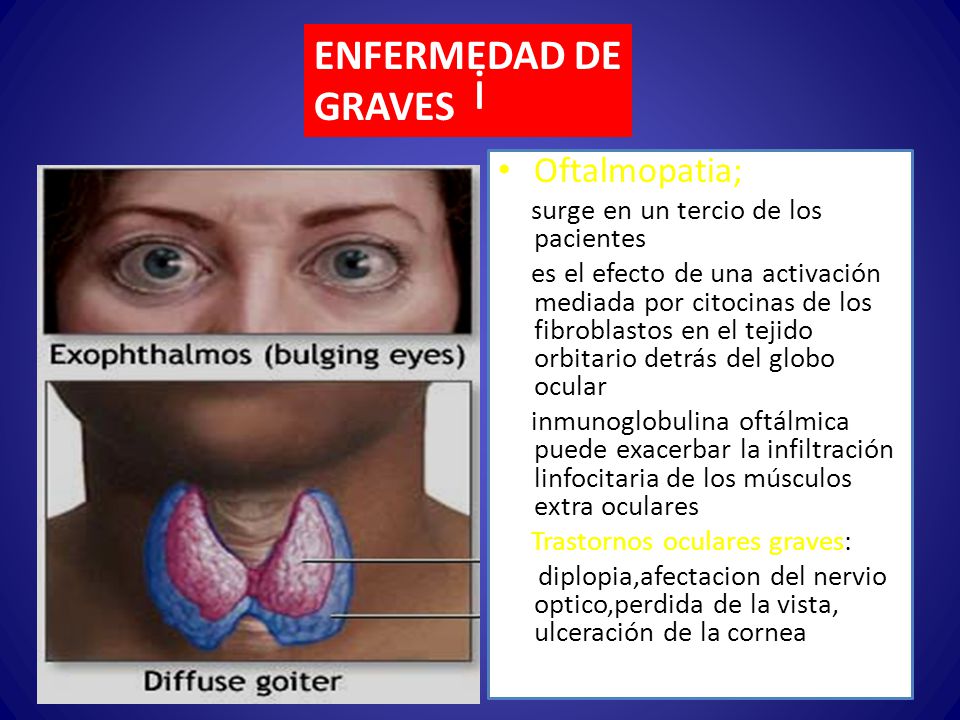 Efectos Del Hipotiroidismo En La Vista