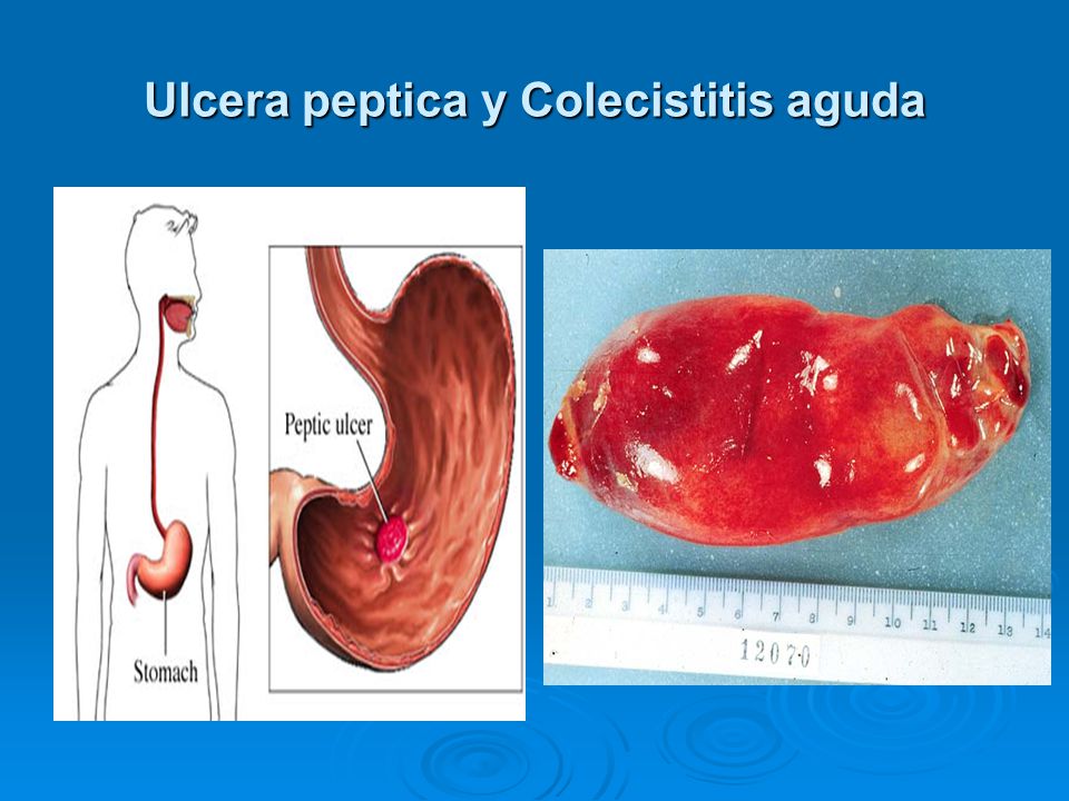 DEFINICION DE DOLOR ABDOMINAL definicion de dolor abdominal: