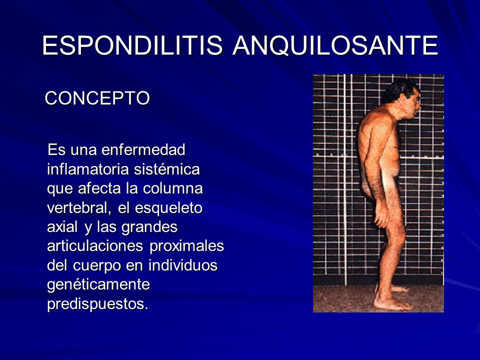 ESPONDILITIS ANQUILOSANTE CONCEPTO CONCEPTO Es una enfermedad inflamatoria sistémica que afecta la columna vertebral, el