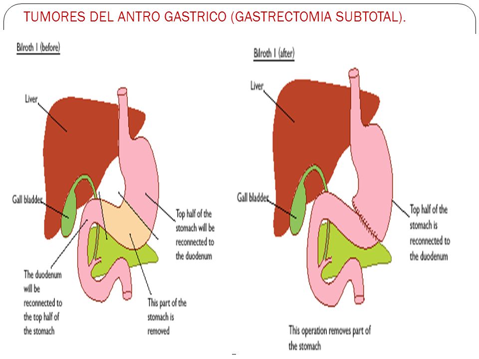 CANCER GASTRICO GASTRECTOMIA cancer gastrico gastrectomia: