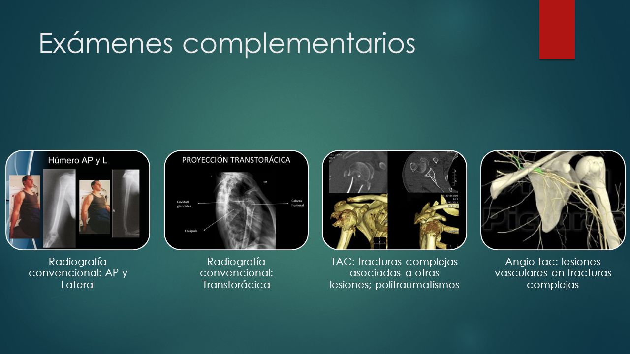 Fracturas De La Di Fisis Humeral Introducci N Se Extienden Distales Al