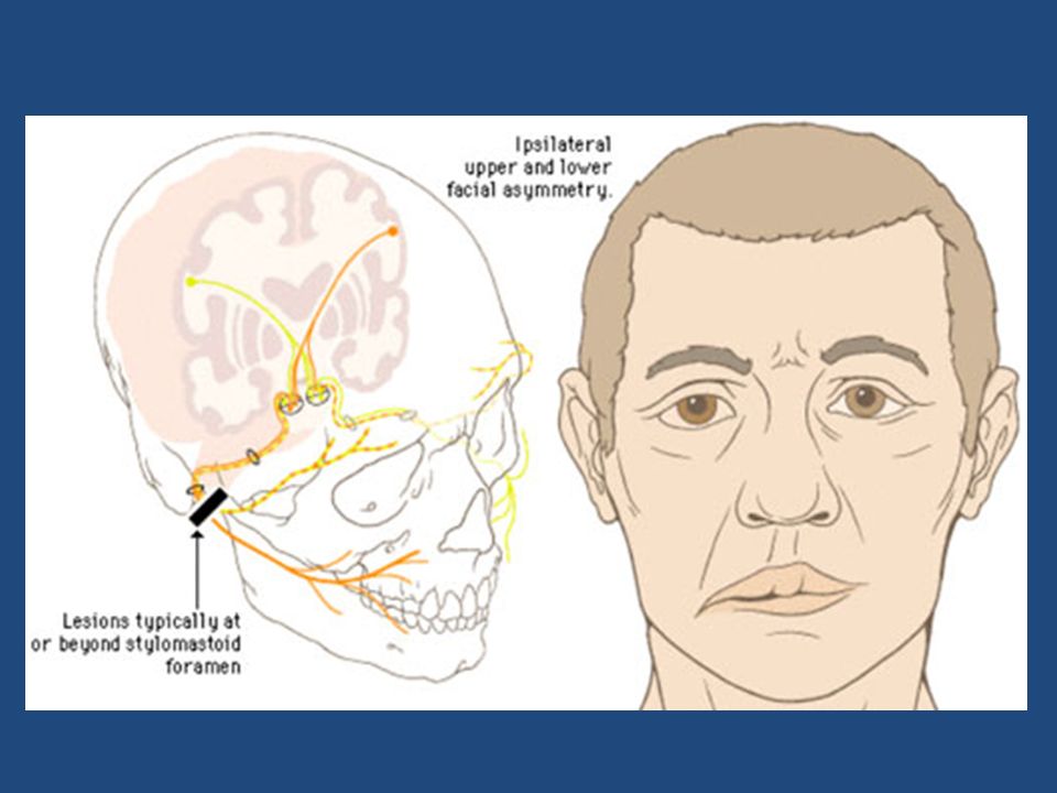 Правый лицевой нерв. Паралич тройничного нерва лица. Асимметрия лица при ЧМТ. Неврит лицевого нерва.