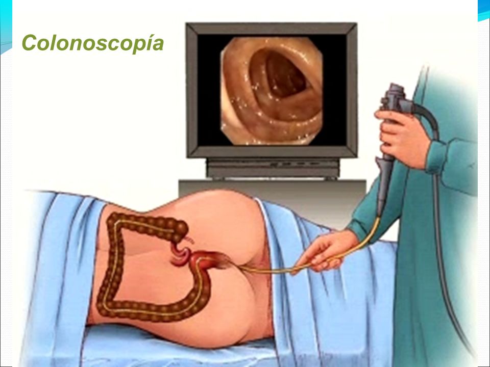 Colonoscopía