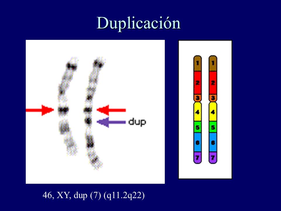 Duplicación Duplicación 46, XY, dup (7) (q11.2q22)
