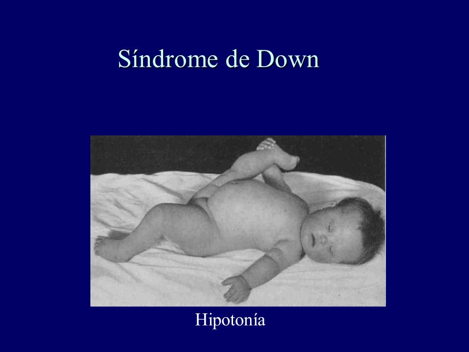 Síndrome de Down Hipotonía