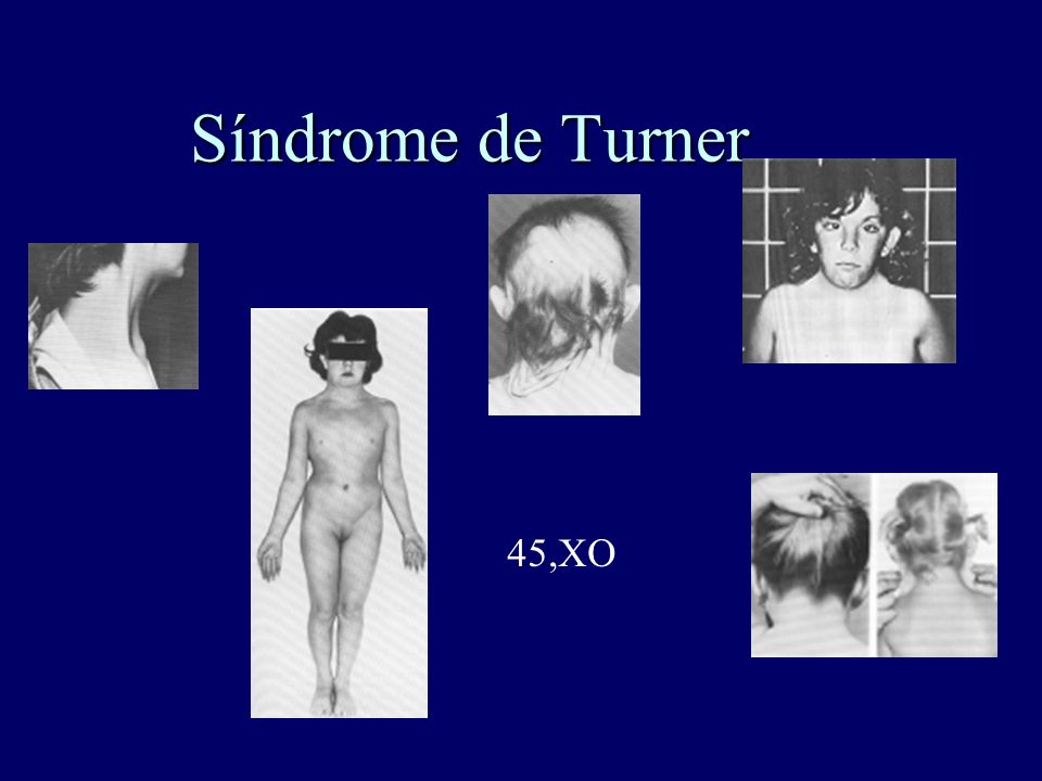 Síndrome de Turner 45,XO