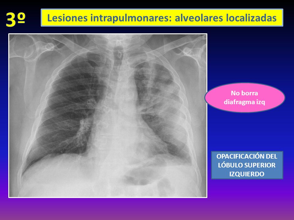 Lesiones intrapulmonares: alveolares localizadas No borra diafragma izq OPACIFICACIÓN DEL LÓBULO SUPERIOR IZQUIERDO