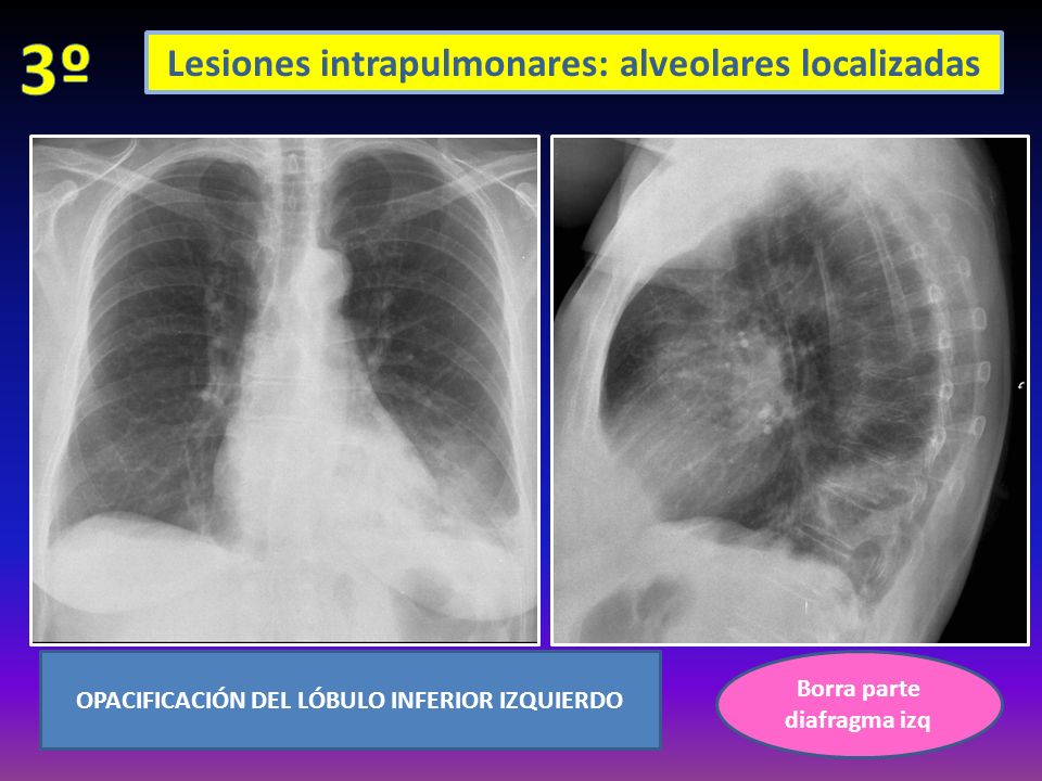 Borra parte diafragma izq OPACIFICACIÓN DEL LÓBULO INFERIOR IZQUIERDO Lesiones intrapulmonares: alveolares localizadas