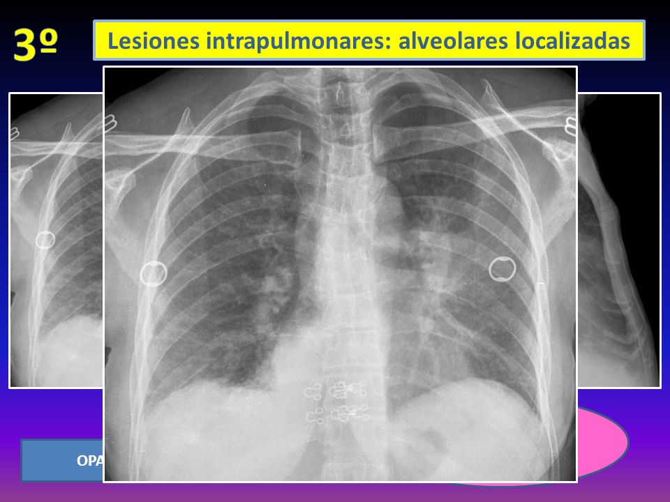 Borra parte contorno cardiaco izquierdo y está limitada por cisura mayor OPACIFICACIÓN DE LÍNGULA Lesiones intrapulmonares: alveolares localizadas
