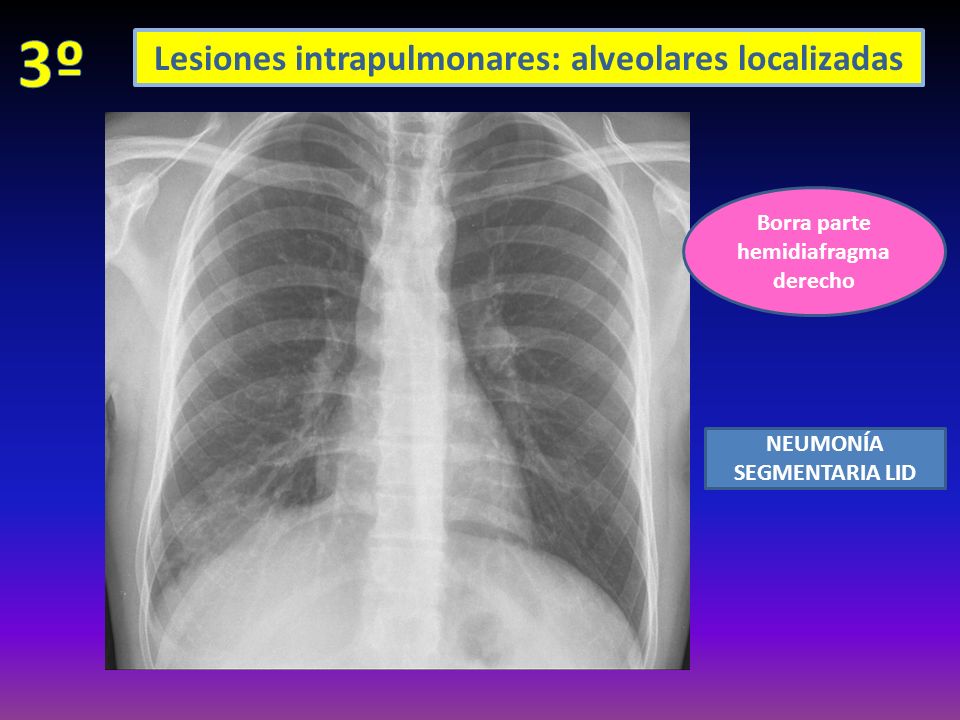 Borra parte hemidiafragma derecho NEUMONÍA SEGMENTARIA LID Lesiones intrapulmonares: alveolares localizadas