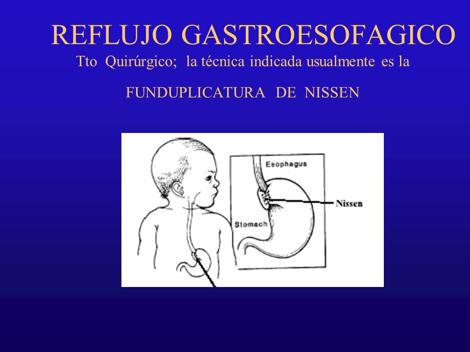 REFLUJO GASTROESOFAGICO Tto Quirúrgico; la técnica indicada usualmente es la FUNDUPLICATURA DE NISSEN