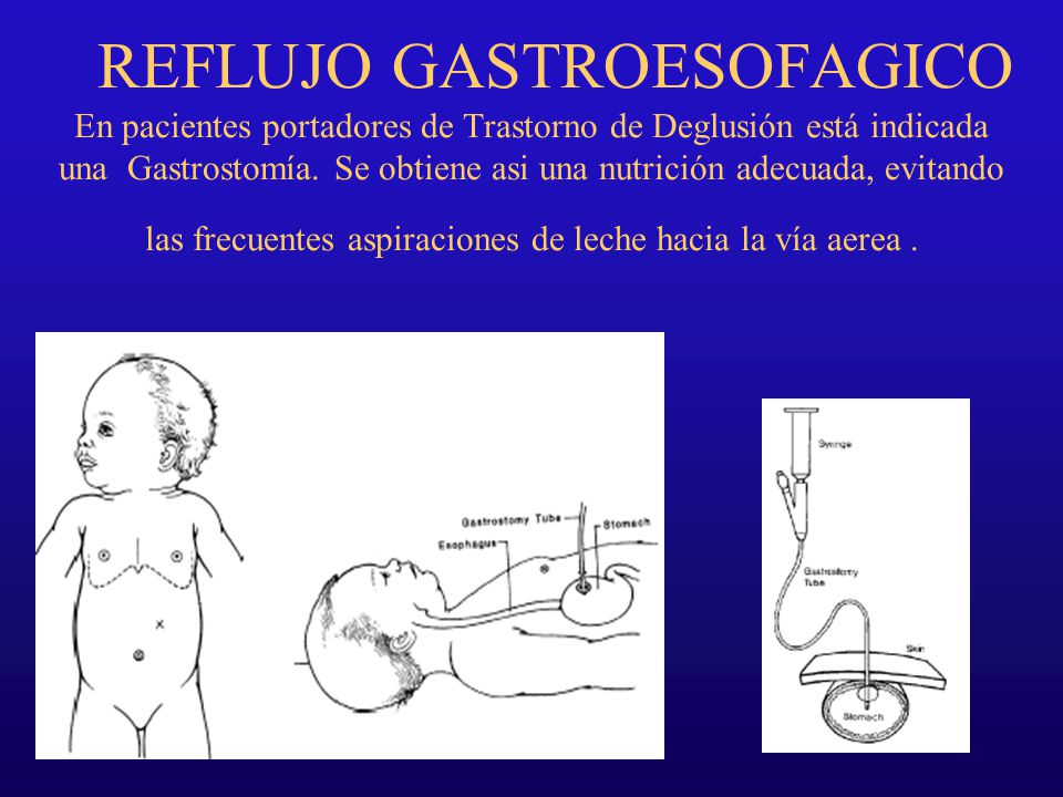 REFLUJO GASTROESOFAGICO En pacientes portadores de Trastorno de Deglusión está indicada una Gastrostomía.