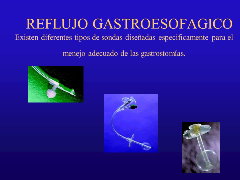 REFLUJO GASTROESOFAGICO Existen diferentes tipos de sondas diseñadas especificamente para el menejo adecuado de las gastrostomías.