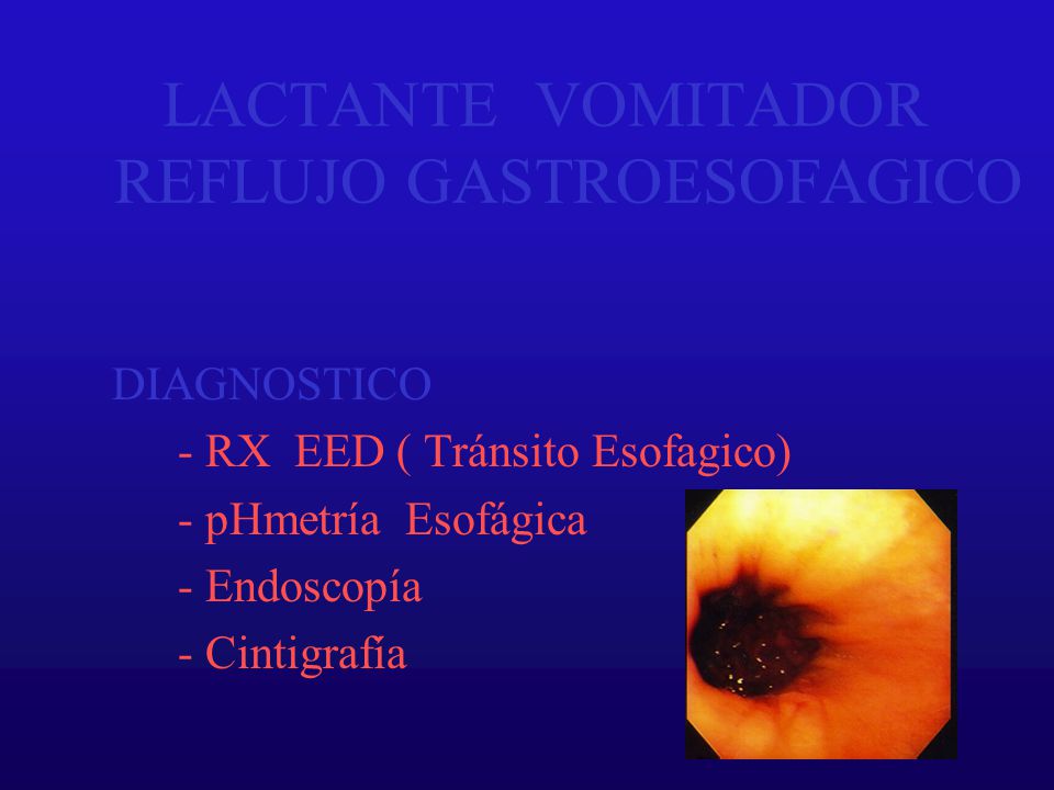 LACTANTE VOMITADOR REFLUJO GASTROESOFAGICO DIAGNOSTICO - RX EED ( Tránsito Esofagico) - pHmetría Esofágica - Endoscopía - Cintigrafía