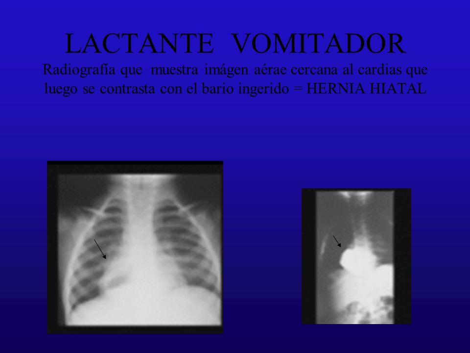 LACTANTE VOMITADOR Radiografía que muestra imágen aérae cercana al cardias que luego se contrasta con el bario ingerido = HERNIA HIATAL