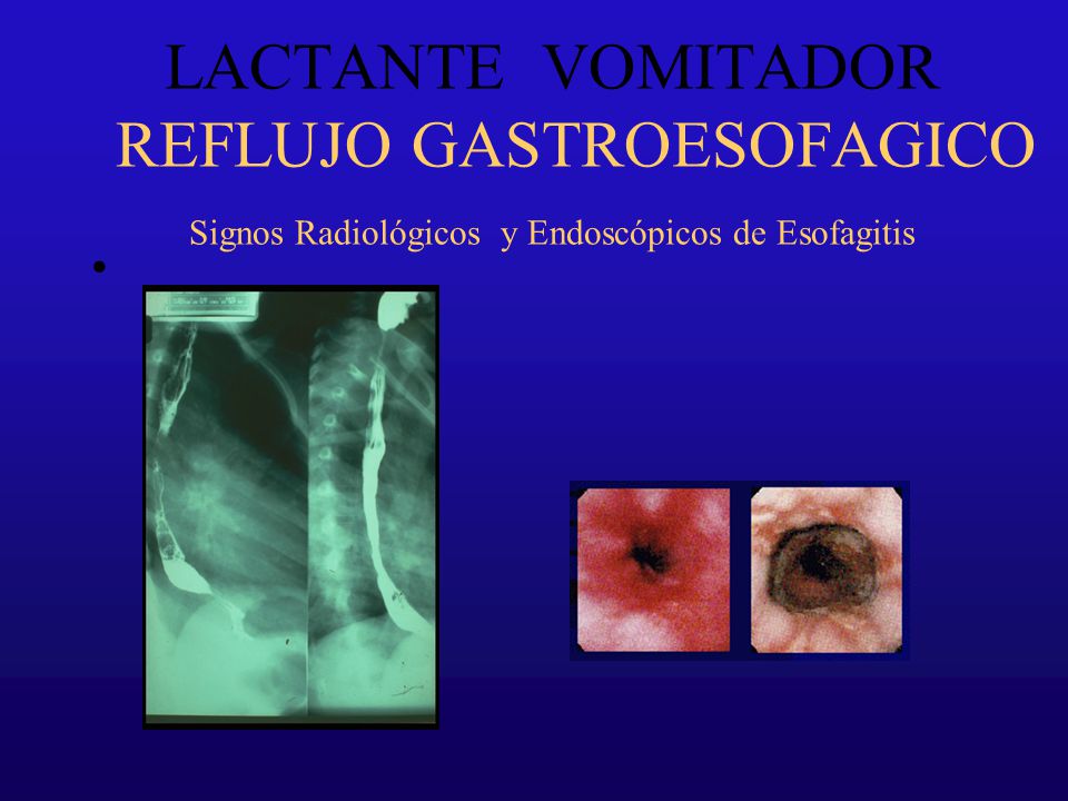 LACTANTE VOMITADOR REFLUJO GASTROESOFAGICO Signos Radiológicos y Endoscópicos de Esofagitis