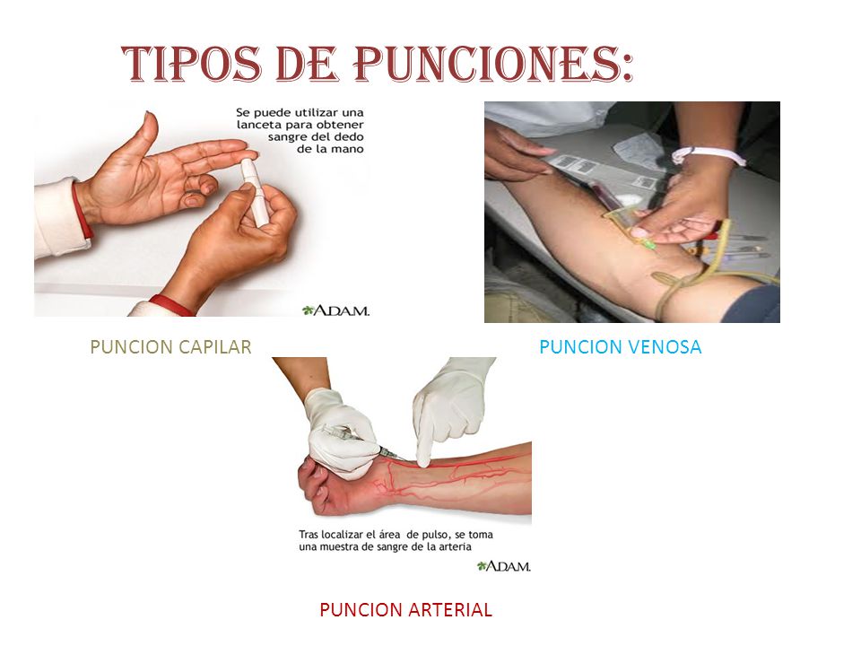 TIPOS DE PUNCIONES: PUNCION CAPILAR PUNCION VENOSA PUNCION ARTERIAL