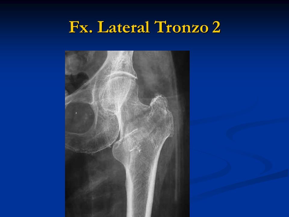 Fx lateral Tronzo 1. Fx. Lateral Tronzo 2 Fx. Lateral cadera Tronzo ppt ...