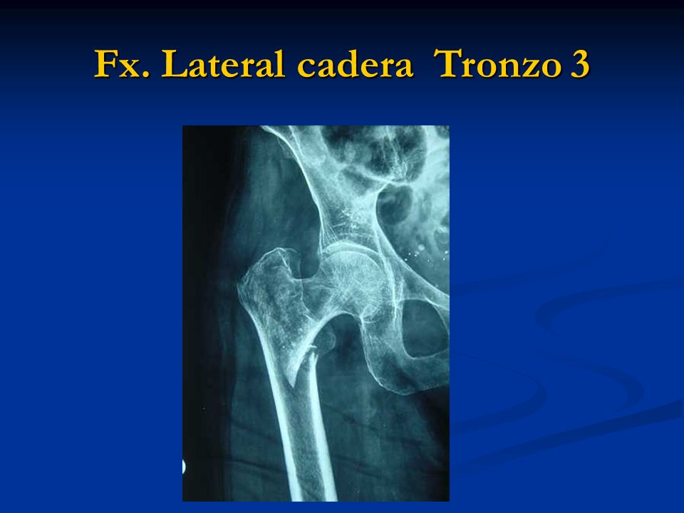 Fx lateral Tronzo 1. Fx. Lateral Tronzo 2 Fx. Lateral cadera Tronzo ppt ...