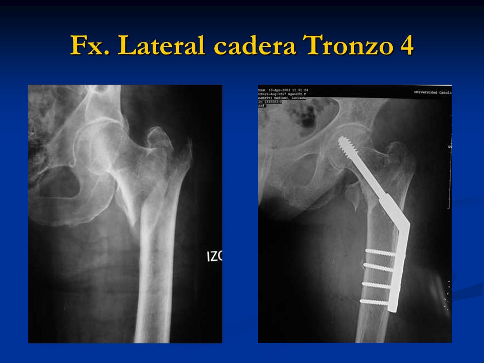 Fx lateral Tronzo 1. Fx. Lateral Tronzo 2 Fx. Lateral cadera Tronzo ppt ...