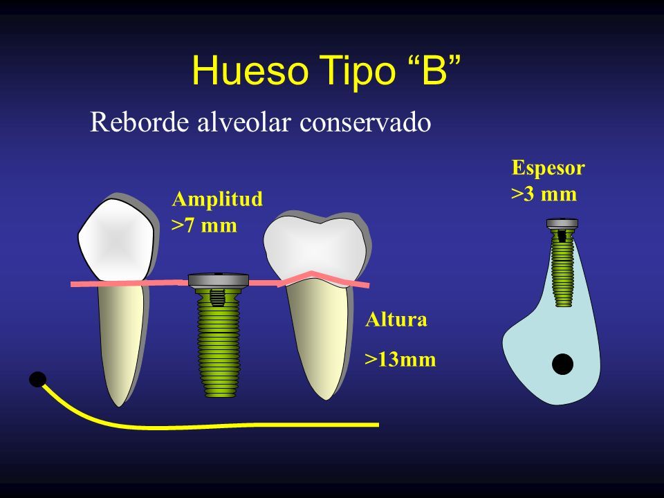 Implantes Dentales Y Cirugía: Principios Básicos Odontólogo ...