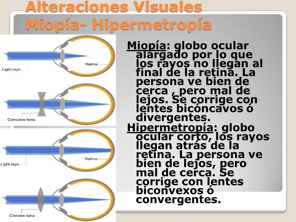 Hipermetropia discount lentes biconvexos