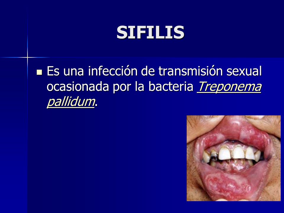 SIFILIS Es una infección de transmisión sexual ocasionada por la bacteria Treponema pallidum.