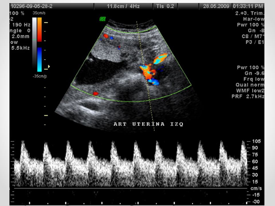 Доплер 2. УЗИ допплерография маточно-плацентарного кровотока. Доплеровский эффект УЗИ. Допплеровское исследование кровотока при беременности. УЗИ допплерография при беременности.