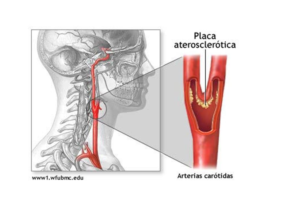 Процент стеноза сосудов. Атеросклероз сосудов шеи сонных артерий. Атеросклероз бифуркации сонной артерии. Холестериновая бляшка в сонной артерии 50 процентов. Атеросклероз и стеноз сонной артерии.