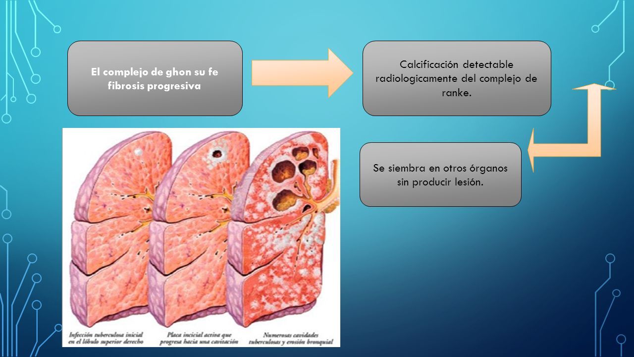 TUBERCULOSIS. TUBERCULOSIS SECUNDARIA El patrón de la enfermedad se ...