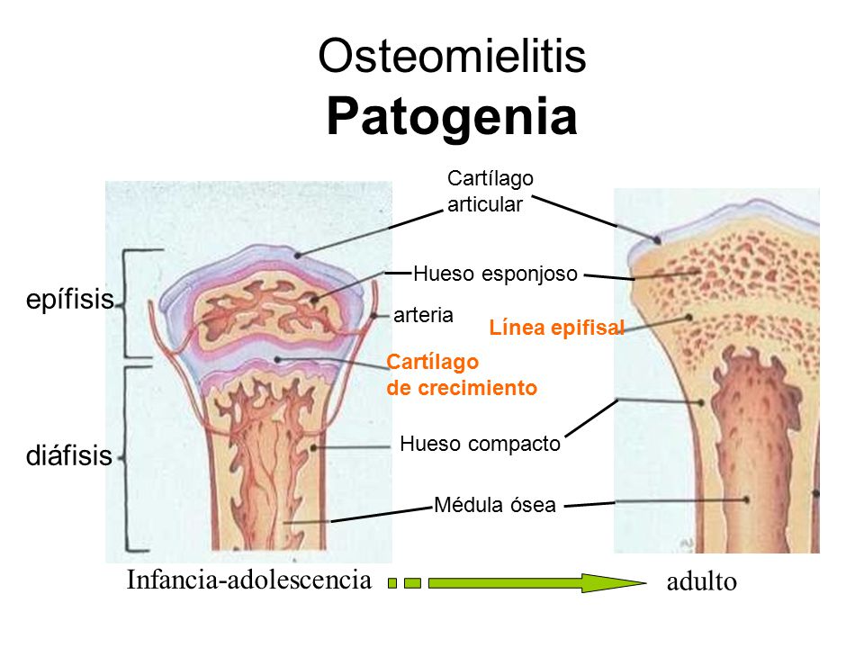 Resultado de imagen de osteomielitis como llega el patogeno a la medula osea