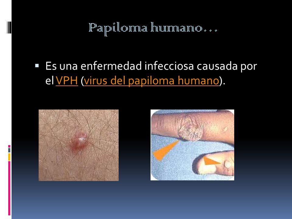 Papiloma humano…  Es una enfermedad infecciosa causada por el VPH (virus del papiloma humano).VPHvirus del papiloma humano