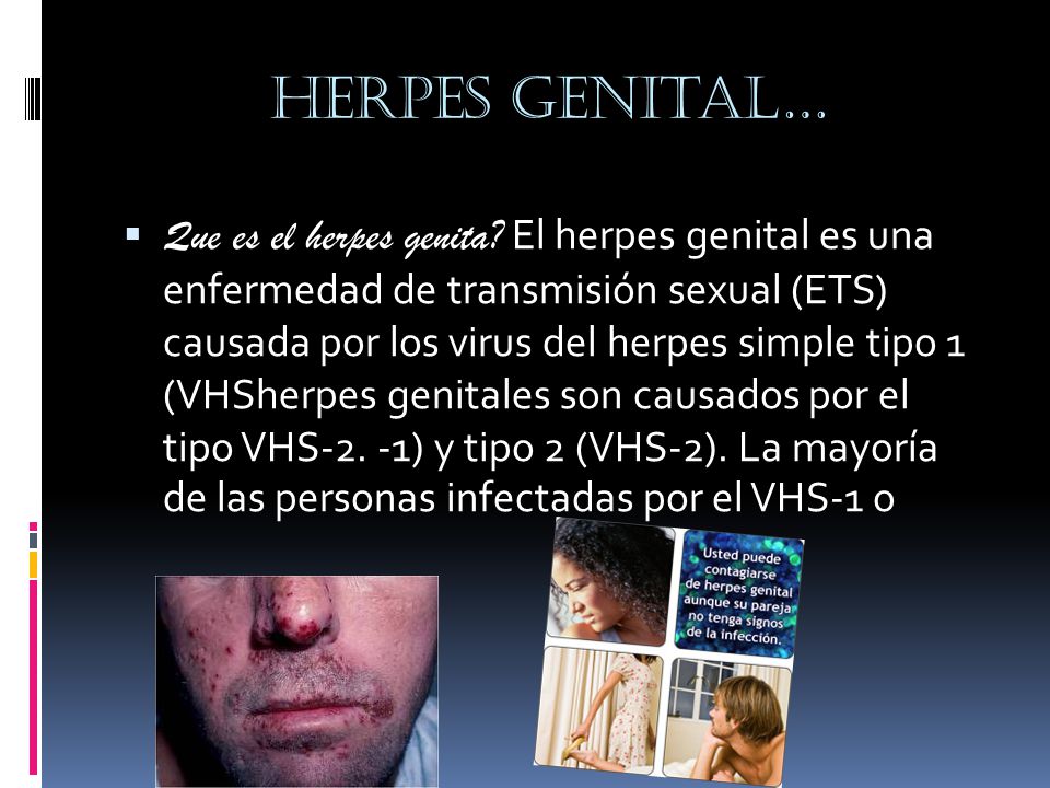 Herpes genital…  Que es el herpes genita.