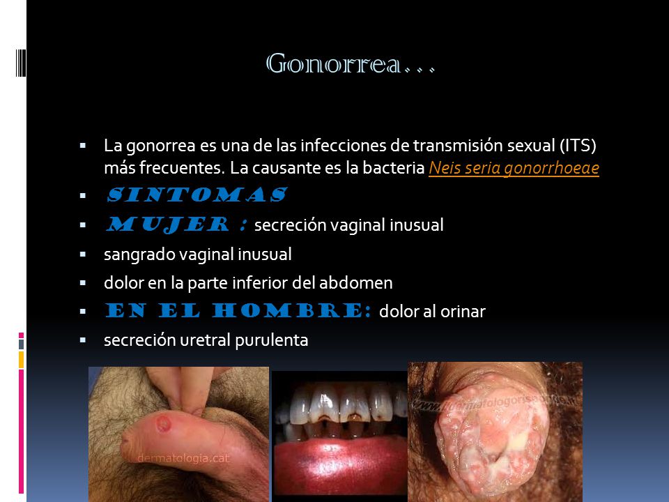 Gonorrea…  La gonorrea es una de las infecciones de transmisión sexual (ITS) más frecuentes.