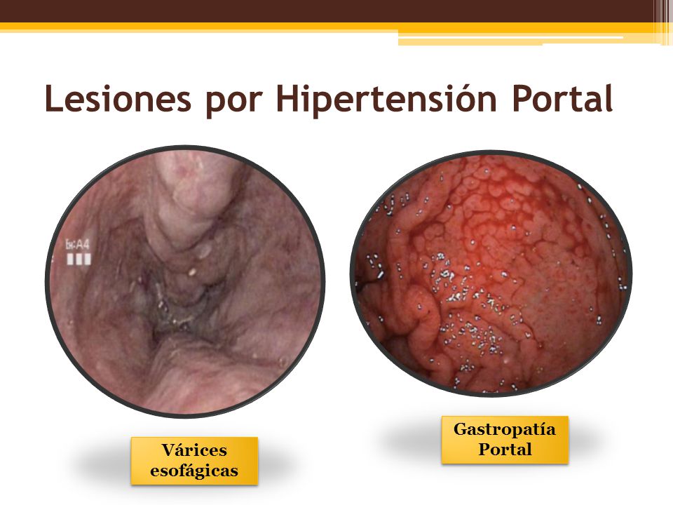 ¿Qué es la gastropatía hipertensiva portal?