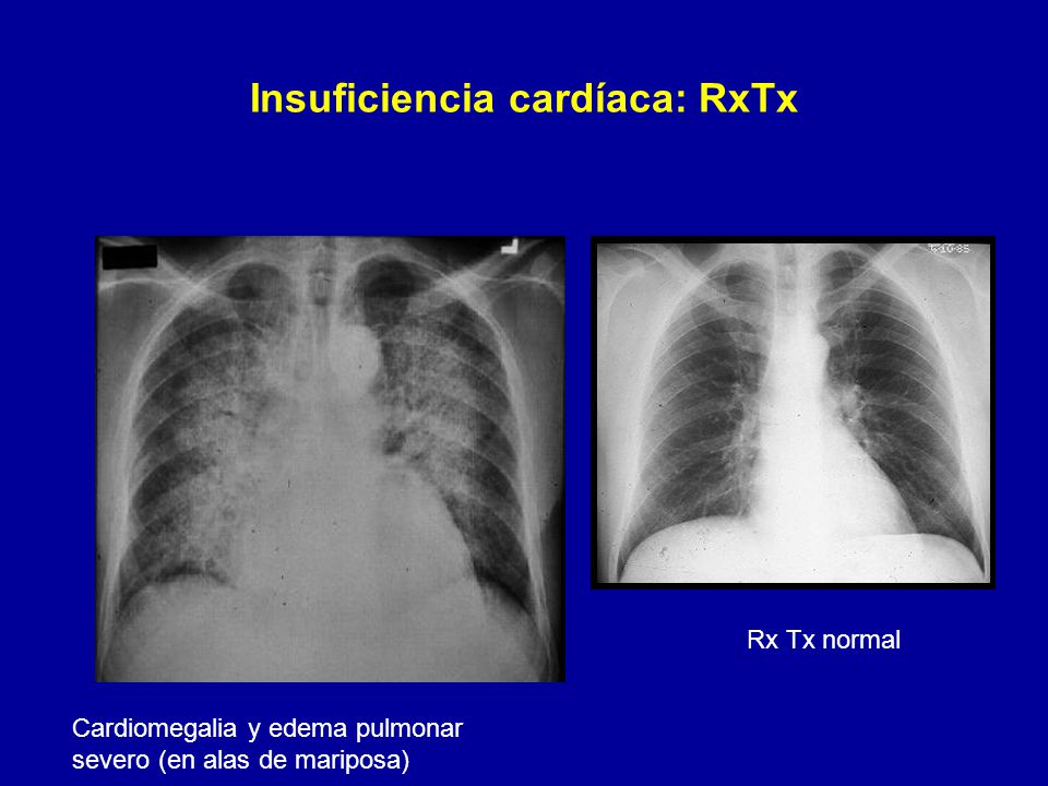 Severo edema pulmonar bilateral