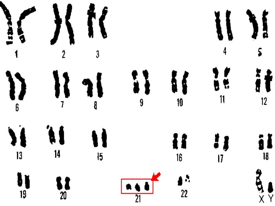 Пересадка хромосом. Синдром Дауна трисомия 21 хромосомы. Трисомия 21 хромосомы (синдром Дауна кариотип. Трисомия по 21 хромосоме кариотип. Синдром Дауна трисомия по 21 хромосоме.