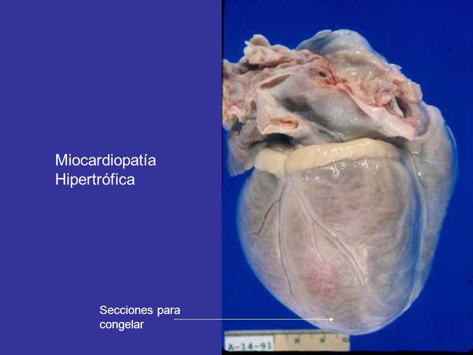 Miocardiopatía Hipertrófica Secciones para congelar